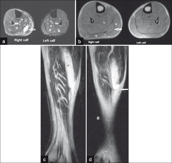 A 59-year year-old male with avulsion injury of plantaris tendon at musculotendinous junction. (a) Axial short tau inversion recovery (STIR) shows hyperintense plantaris tendon (open white arrow) beneath the gastrocnemius (G) and superficial to soleus (S) in the right calf. Normal left calf is seen. (b) Axial T1 shows isointense plantaris tendon (open white arrow) beneath the gastrocnemius (G) and superficial to soleus (S) in the right calf. (c,d) Serial Sagittal T2 images of leg show the plantaris tendon (P) avulsion and proximal retraction of torn end (arrow in figure d).