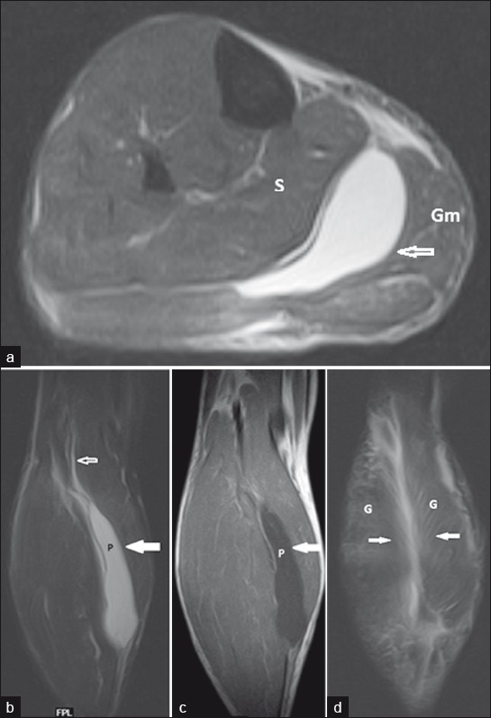 A 40-year year-old male with rupture of plantaris muscle and Grade 1 injury of gastrocnemius muscles in the right calf. (a) Axial short tau inversion recovery (STIR) of calf shows fluid collection (open white arrow) hyperintense on short tau inversion recovery (STIR) between the gastrocnemius medial head (Gm) and soleus (S) muscles which represents the torn plantaris muscle. (b) Coronal short tau inversion recovery (STIR) of calf shows a hyperintense fluid collection (solid arrow) between the gastrocnemius and soleus (S) muscles which represents the torn plantaris muscle (P). Superiorly it extends upto the lateral condyle of femur (open white arrow), the site of origin of plantaris tendon. (c) Coronal T1 (figure c) of calf shows fluid collection (solid arrow) hypointense on T1 between the gastrocnemius and soleus muscles which represents the torn plantaris muscle. (d) Coronal short tau inversion recovery (STIR) of calf that shows hyperintense signal (solid arrows) in a part of the gastrocnemius muscles (G) in the calf, represents Grade 1 injury.
