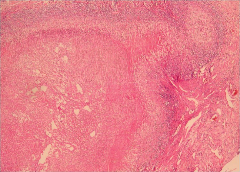 A 38-year-old female with hepatic fascioliasis: Photomicrograph of a liver specimen shows parasitic granuloma with necrosis surrounded by heavy mononuclear and eosinophilic infiltration. Surrounding liver parenchyma shows fibrosis with inflammation (H and E, 40×).