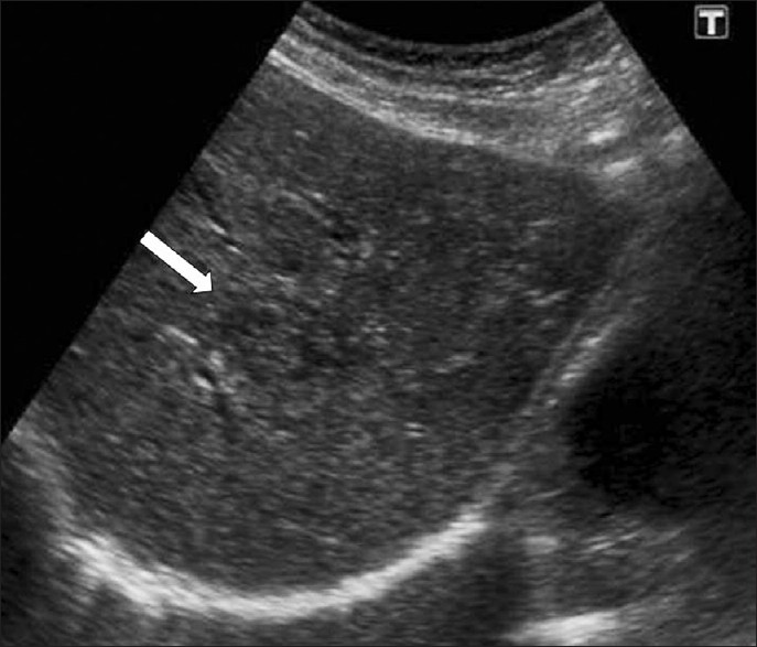 Parenchymal phase of fascioliasis. US shows a parenchymal focal lesion with a halo around it within the liver (arrow).