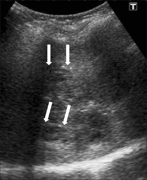 Periportal tracking. US shows linear hypoechogenicity (arrows) along the intrahepatic bile ducts.