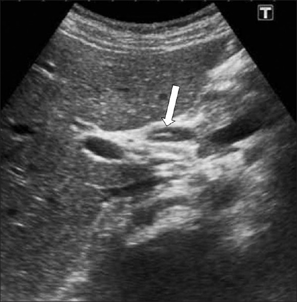 F. hepatica worms. US demonstrates a linear echogenic material (arrow) within the dilated common hepatic duct representing a dead F. hepatica worm.