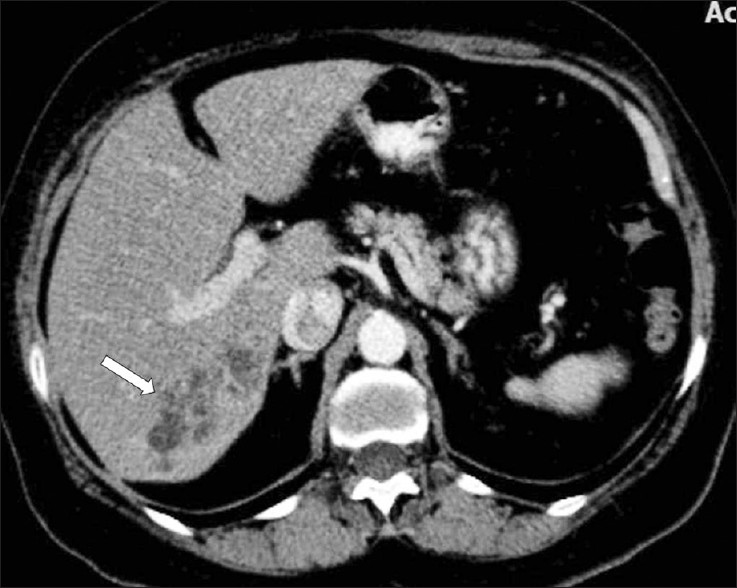 A contrast-enhanced CT scan demonstrates multiple, round, clustered, hypodense lesions, with peripheral contrast enhancement in the liver (arrow).