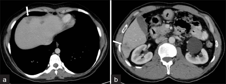 Infiltration of the liver in the early parenchymal phase. Contrastenhanced CT scan shows irregular low attenuation lesions (arrows) in the subcapsular portion of the (a) left and (b) right hepatic lobes (two different patients).