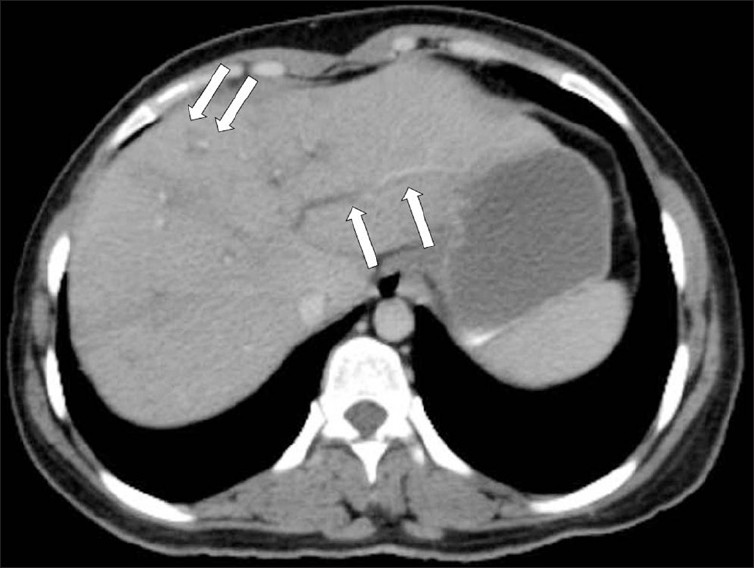 A contrast-enhanced CT scan shows low attenuation tracks (arrows) along the portal triads.