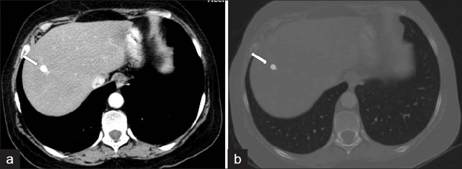 A CT scan shows (a, b) residual parenchymal calcification (arrow) after treatment, in a patient with F. hepatica.