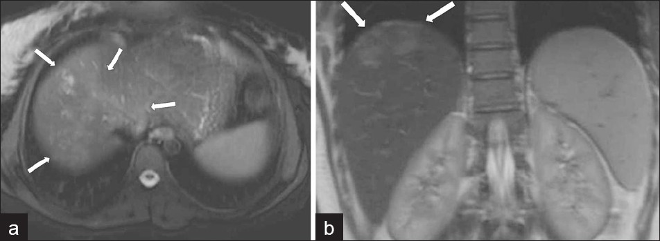 (a) Axial and (b) coronal T2W MR images show more prominent serpigineous hyperintense lesions in the liver (arrows in a) and a hyperintense glisson capsule (arrows in b).