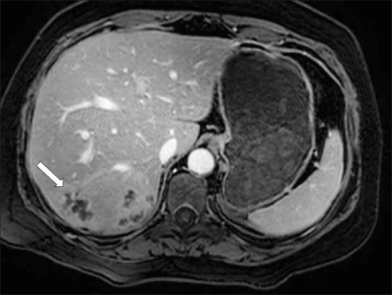 A contrast-enhanced T1W MR image shows multiple, round, clustered hypodense lesions with peripheral contrast enhancement (arrow) in the liver (same patient in Figure 7)