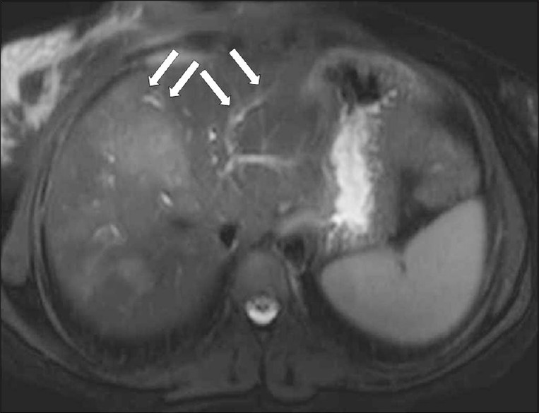 A T2W axial MR image shows hyperintense tracks (arrows) along the portal veins.