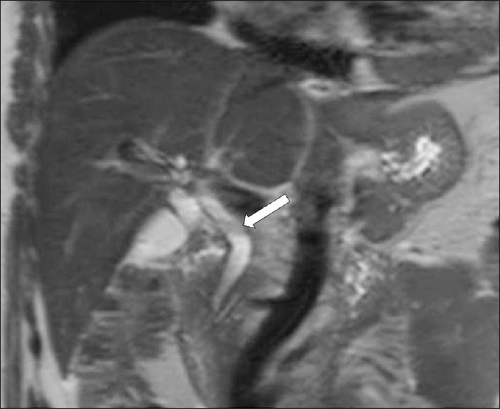 F. hepatica worms. T2W coronal MR image shows mild dilatation of the common bile duct, and a filling defect (arrow).