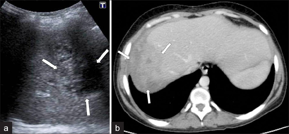 Complicated parenchymal lesions: Abscess formation, (a) US demonstrates an irregular-shaped lesion containing heterogeneous anechoic areas (arrows). (b) A contrast-enhanced CT scan shows (same patient) an irregular heterogeneous lesion with irregular peripheral enhancement (arrows).