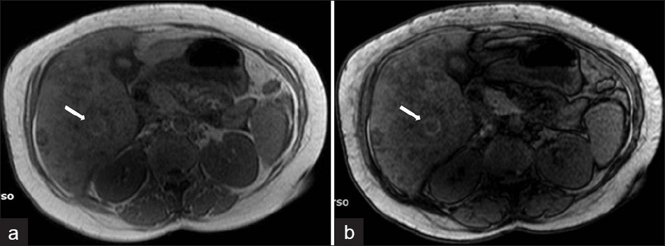 Complicated parenchymal lesions: Hemorrhagic infarction: (a) T1W in-phase MR image shows rim-shaped hyperintense lesion (arrow). (b) T1W out-of-phase MR image shows rim-shaped hyperintensity without signal loss (arrow).