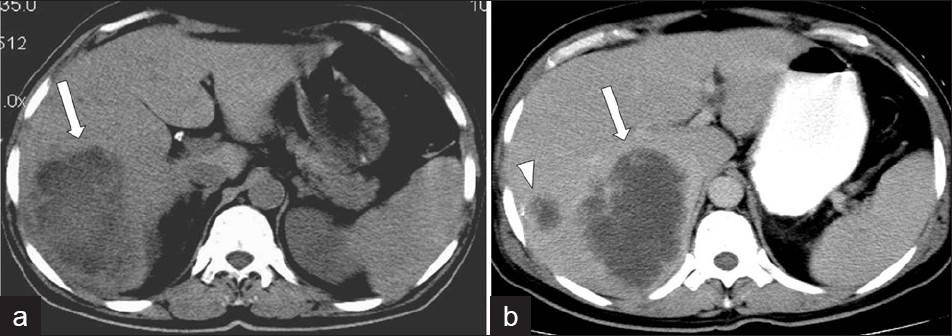 Amebic liver abscess.(a) Non-contrast and (b) Contrast-enhanced CT scan demonstrates a large, lobulated, well-defined cystic mass in the right hepatic lobe, with enhanced thick wall (arrow), and a satellite cystic mass associated with the same imaging features.