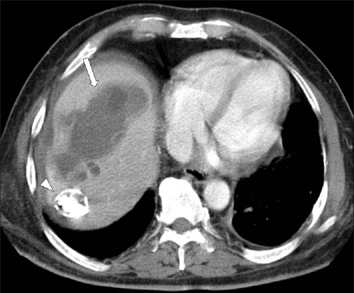 A contrast-enhanced CT scan demonstrates a large, multilocular hydatid cyst in the right hepatic lobe, with multiple daughter cysts (arrow). Note a subtotally calcified lesion in the seventh segment of the liver (arrow head).