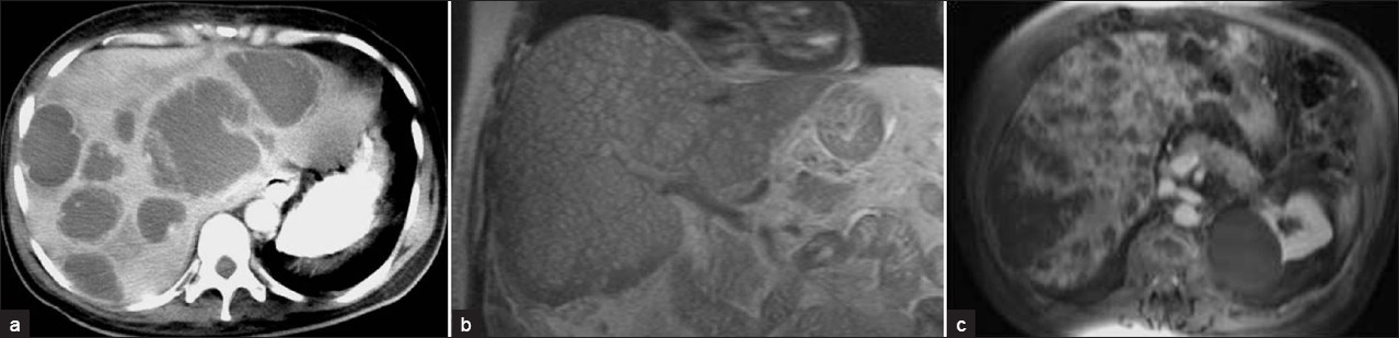 Pyogenic multiple liver abscesses.(a) Contrast-enhanced CT scan shows multiple hypoattenuating lesions representing pyogenic abscesses scattered throughout the liver. These lesions demonstrate peripheral enhancement and surrounding edema. (b) Coronal MR T2W HASTE images and (c) contrast-enhanced MR images show multiple small hyperintense nodules representing pyogenic microabscesses disseminated in the liver, with peripheral contrast enhancement.