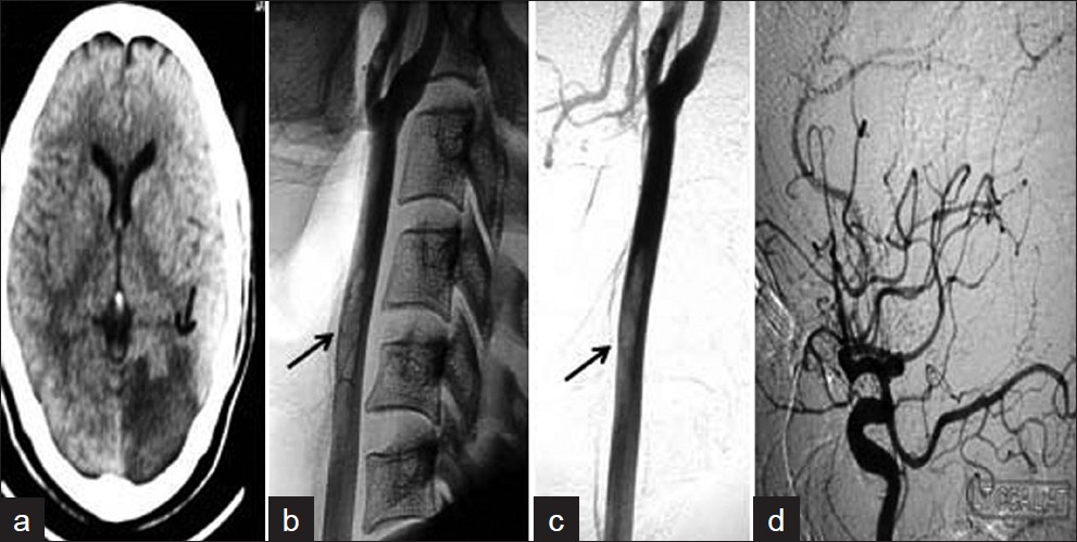 Patient 1 (a) CT scan shows infarct in the left PCA territory (arrow) and (b, c) angiogram shows the cigar-shaped thrombus (arrows) in the left CCA. (d) Angiogram (lateral view) shows the fetal PCA.