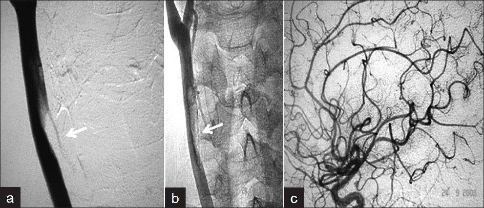 Patient 2 (a, b) Right CCA angiogram shows the filling defect suggestive of mural thrombus and (c) normal intracranial cerebral circulation.