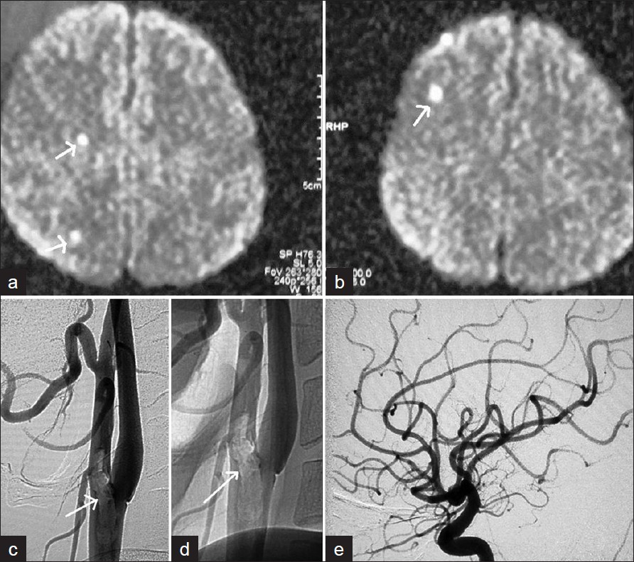 Patient 3 (a, b) MR shows small foci of restricted diffusion suggesting acute infarcts in the right MCA territory (arrows). Patient 3 (c,d) Right CCA angiogram on lateral views shows filling defect (arrows) in the distal common carotid artery extending into the external carotid artery. (e) Intracranial cerebral angiogram is normal.