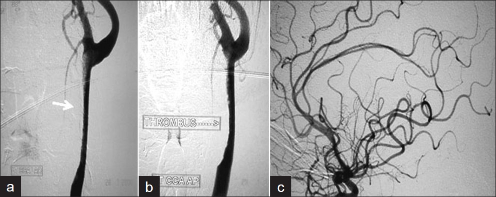 Patient 4 (a,b) Left CCA angiogram shows cigar-shaped partially adherent mural thrombus in the left CCA and (c) normal intracranial circulation.