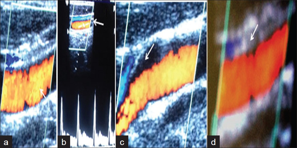 Follow-up carotid Doppler images of (a) Patient 1 (b) Patient 2 (c) Patient 3 and (d) Patient 4 show complete dissolution of thrombus with normal flow in the artery.