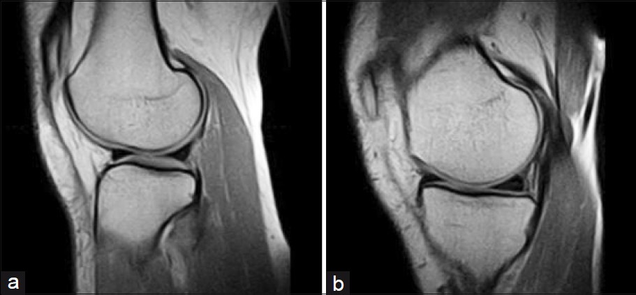 Sagittal view of the knee shows (a) normal meniscus, (b) medial meniscus posterior horn Grade 3.