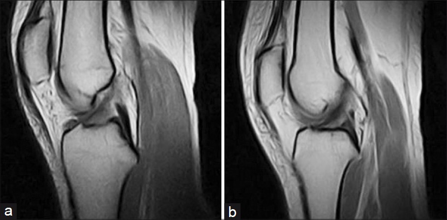Sagittal view of the knee shows (a) normal anterior cruciate ligament, and (b) ACL tear Grade 2.
