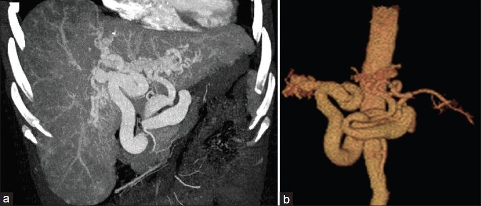 CT images before surgery in Case 1. Figure 1a is coronal MIP reconstructed image in arterial phase that shows tortuous and irregular arteries in liver and portahepatis. Heterogeneity of the contrast enhancement in hepatic parenchyma with multiple opacified vessel masses is also observed. (b) VRT image shows two tortuous and distended arteries derived from the celiac trunk supplying the left and right lobes of the liver.