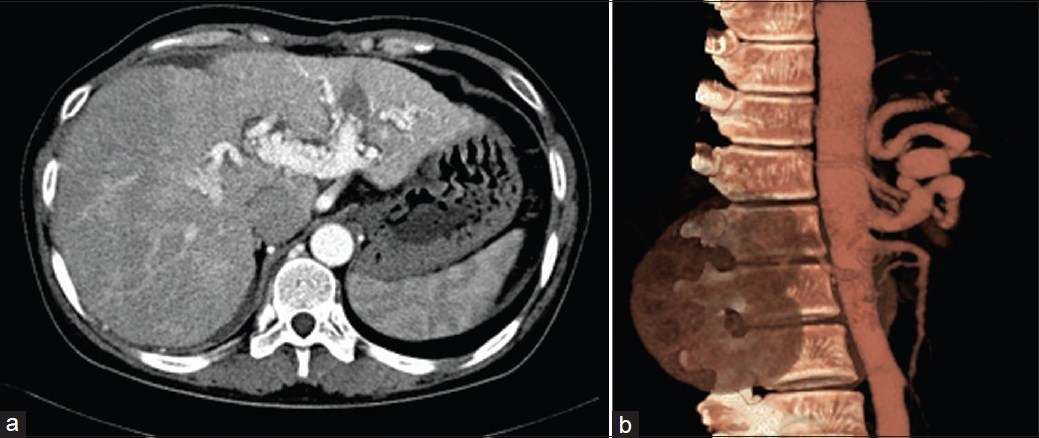 CT images after surgery in (a) arterial phase and (b) VRT respectively. The arteries in porta hepatis are decreased compared with those before operation.