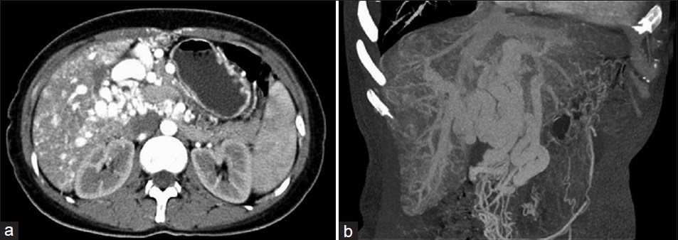 CT images in arterial phase and VRT respectively in Case 2. Irregular and tortuous arteries in the liver parenchyma, and porta hepatis are present. The intra-hepatic billary ducts are dilated. Splenomegaly with gastric varices is identified.