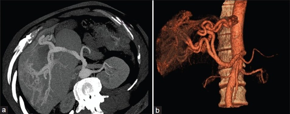CT images in arterial phase and VRT respectively in Case 3. Enlarged caudate lobe is present. Tortuous vessels are observed in the porta hepatis.