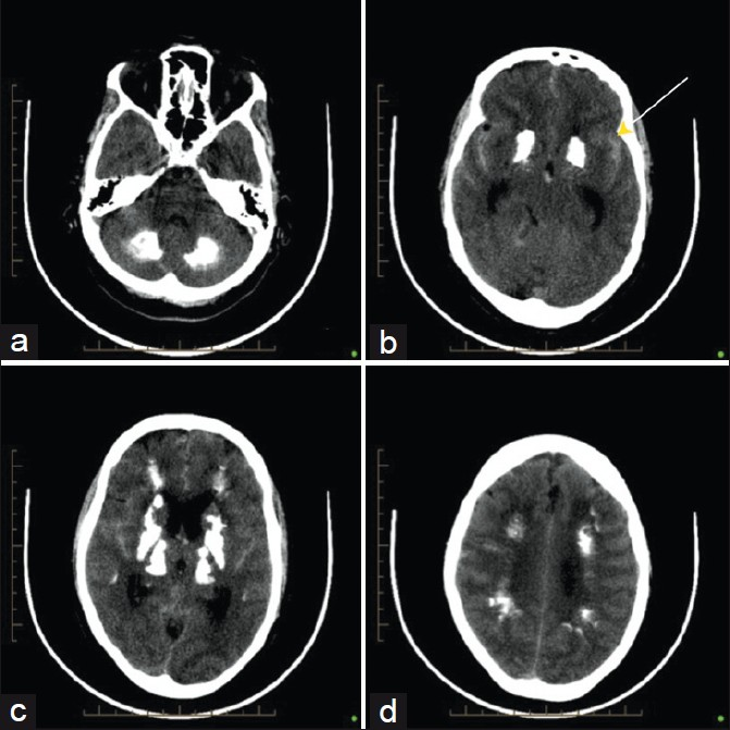 Axial noncontrast CT scan of the brain shows extensive symmetrical calcification at the level of the (a) cerebellum, (b) basal ganglia, (yellow arrow) (c) thalamus and (d) White matter.