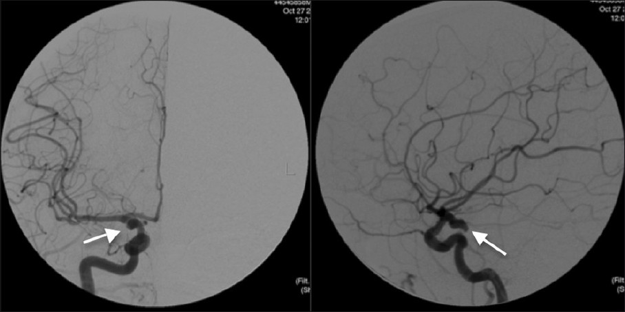 Right internal carotid angiogram showing a multilobulated right posterior communicating artery aneurysm measuring 7.8 × 5.7 × 4.2 mm with the neck of the aneurysm measuring 3.3 mm (white arrow).