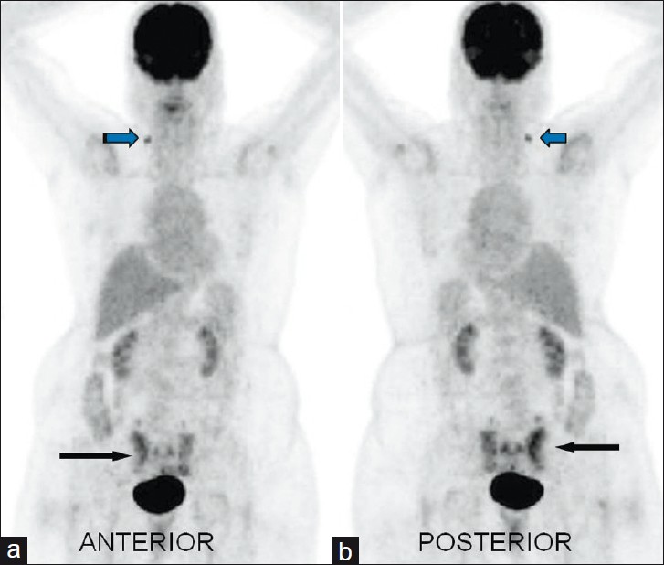 The F-18 FDG PET-CT (maximum intensity projection image) (a) Anterior and (b) posterior show focal low-grade tracer uptake in right level IV cervical lymph node (nonspecific) blue arrow, and vertical linear FDG uptake medial to bilateral sacroiliac joint and horizontal uptake which connects vertical line (H-shaped/ Butterfly shaped) (black arrow) in the sacral region. Standardized uptake maximum value of sacral uptake based on body surface area was 5.8 gm/ml.