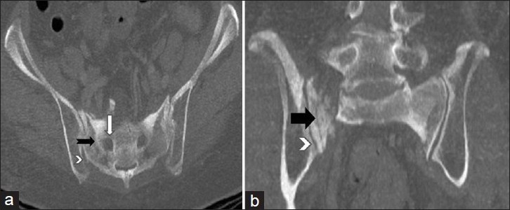 The (a) axial and (b) coronal Maximum Intensity Projection (MIP) CT images show lucent fracture line (black arrow) with breach in the anterior cortex of right sacral ala. The fracture line is away from the right sacral foramina (white arrow) and medial to the sacroiliac joint (arrowhead).