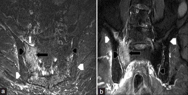 Nuclear magnetic resonance (NMR) images of sacral spine. Short tau inversion recovery (STIR) weighted (a) axial and (b) coronal images through the sacrum revealed complete diffuse hyperintensity of the right sacral ala (black arrow) suggestive of bone marrow bruise/edema. There is also mild hyperintensity in the soft tissue anterior (white arrow) to the right sacral ala suggestive of changes related to bone injury. Bilateral SI joints (black arrowhead) and bilateral iliac bones (white arrowhead) appear unremarkable. These features were suggestive of sacral insufficiency fracture.