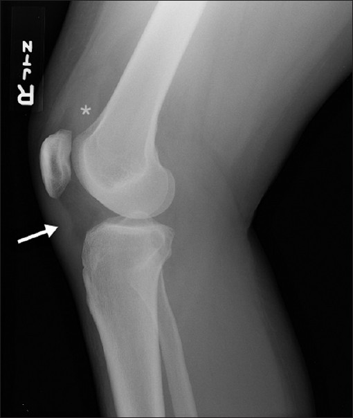 Lateral radiograph of the right knee following the initial injury demonstrates a large suprapatellar joint effusion (asterisk) and undulating contour of the patellar tendon (arrow).