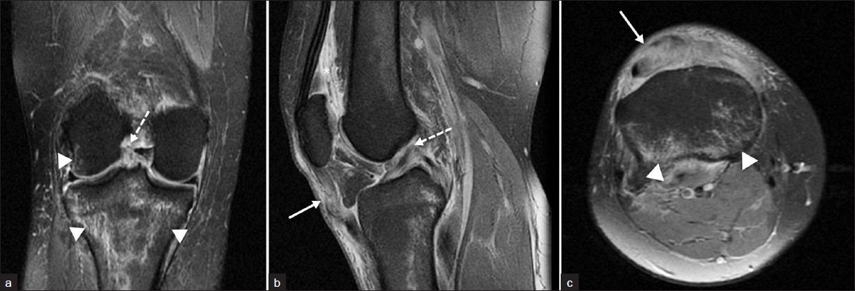 T2-weighted fast spin echo fat-suppressed images of the right knee. (a) Coronal image shows complete absence of anterior cruciate ligament fibers (broken arrow) consistent with a complete tear. There is also contusion within the posterior medial and lateral tibial plateau (arrowhead) and lateral femoral condyle (arrowhead). (b) Sagittal image with a large joint effusion (asterisk), undulation of the patellar tendon (arrow), and complete tear of the anterior cruciate ligament (dashed arrow). (c) Axial image demonstrates near complete tear of the patellar tendon (arrow) and edema within the posterior tibial plateau (arrowheads).