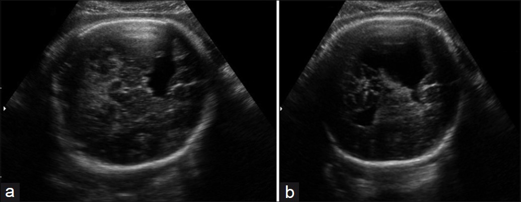(a) and (b) Prenatal 2DUS images show the presence of a large cleft in the left parietotemporal region of the brain, extending to the lateral ventricle. 2DUS: two-dimensional ultrasound.