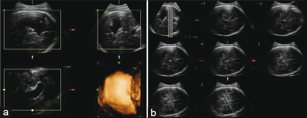 (a) Prenatal 3DUS images in multiplanar mode (top right — axial plane; top left — sagittal plane; lower right — coronal plane; lower left — rendering mode) clearly show the spatial relationship between the cleft (white arrow) and the ventricular system. (b) 3DUS in TUI mode (eight axial sequential planes, with 2.0 mm intervals) shows the lesion level. 3DUS: threedimensional ultrasound; TUI: tomographic ultrasound imaging.