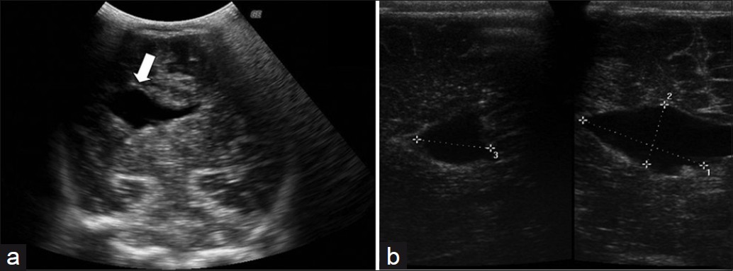 A postnatal trans-fontanel 2DUS, shows (a) the location of the cleft in the cerebral hemisphere (white arrow) and (b) its measurements in the axial (right) and sagittal (left) planes. 2DUS: two-dimensional ultrasound.