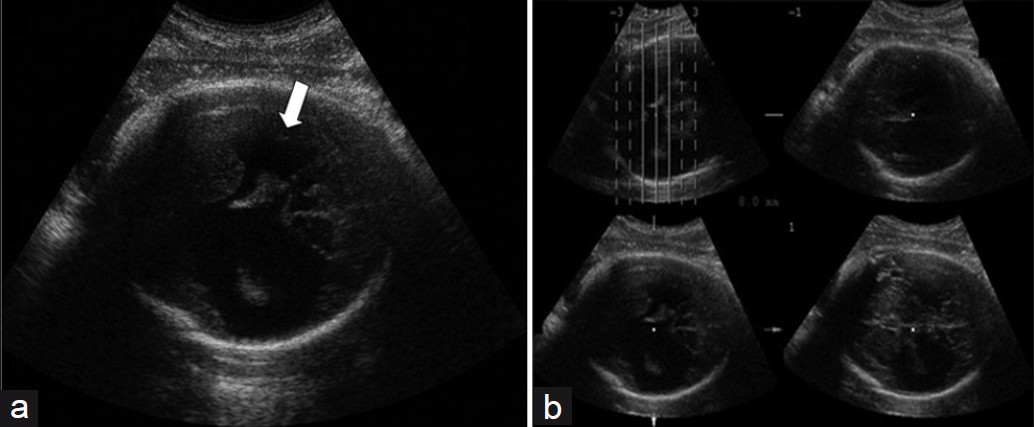 (a) Prenatal 2DUS reveals bilateral schizencephaly with a cleft going up to both hemispheres (white arrow). (b) 3DUS in TUI mode (four axial sequential planes, with 8.0 mm intervals), clearly shows that the cleft goes up to the subarachnoid space, thus confirming that it is Type II. 2DUS: two- dimensional ultrasound; 3DUS: three-dimensional ultrasound; TUI: tomographic ultrasound imaging.