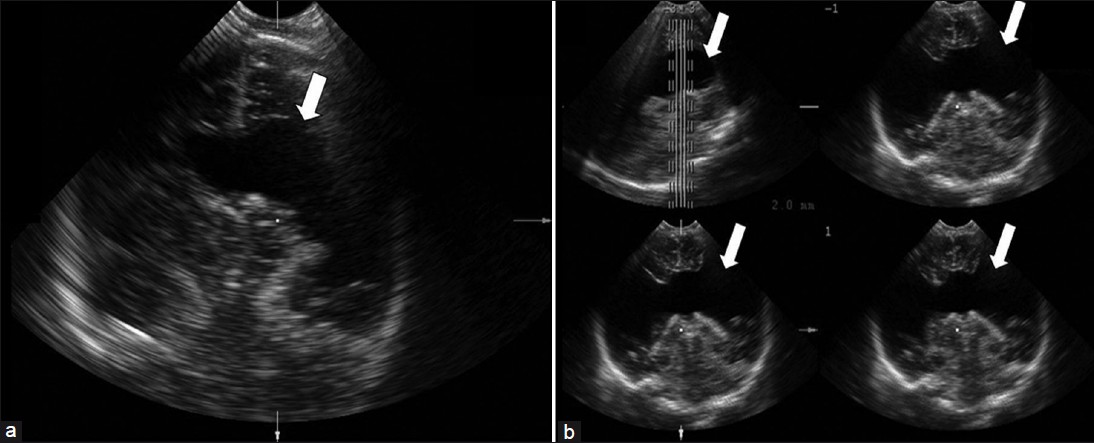 (a) Postnatal trans-fontanel 2DUS, making it obvious that the cleft extends to the subarachnoid space (Type II) (white arrow). (b) Trans-fontanel 3DUS in TUI mode (four sagittal sequential planes, with 2.0 mm intervals) demonstrate that the cleft extends bilaterally to the subarachnoid space, thus proving that it is Type II (white arrows). 2DUS: two-dimensional ultrasound; 3DUS: three-dimensional ultrasound; TUI: tomographic ultrasound imaging.