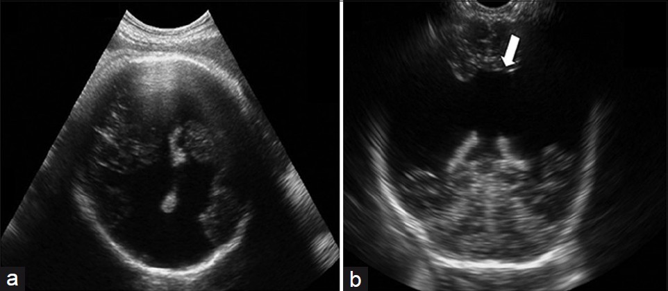 (a) Prenatal and (b) postnatal 2DUS findings in a case of extensive bilateral schizencephaly, reaching the subarachnoid (Type II) space, with widespread destruction of the brain parenchyma (white arrow). 2DUS: twodimensional ultrasound.