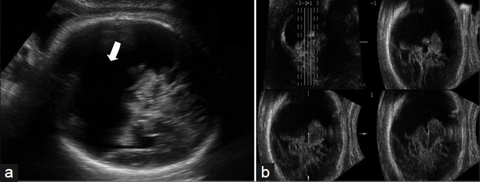 (a) Prenatal 2DUS in a case of extensive bilateral schizencephaly, with a large posterior cystic cavity, suggesting holoprosencephaly (white arrow); (b) 3DUS in TUI mode (four coronal sequential planes, with 3.0 mm intervals) proved that this was schizencephaly Type II, because of non-fusion of the thalami. 2DUS: two-dimensional ultrasound; 3DUS: three-dimensional ultrasound; TUI: tomographic ultrasound imaging.