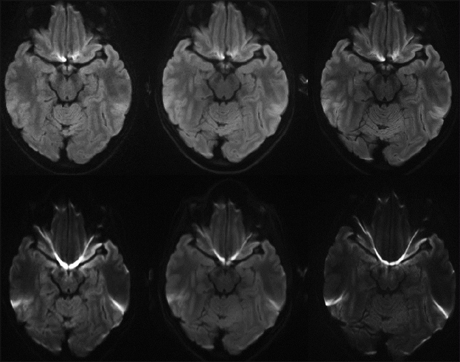 Representative images at 3 T including: single-shot echo planar imaging (ss-EPI) (bottom left) and readout-segment echo planar imaging (rs- EPI) obtained with a 12-channel head coil (top left), as well as low artifact (IPAT 3) 32-channel coil scans with rs-EPI (top middle) and ss-EPI (bottom middle), in addition to high resolution rs-EPI (top right) and ss-EPI scans (bottom right).