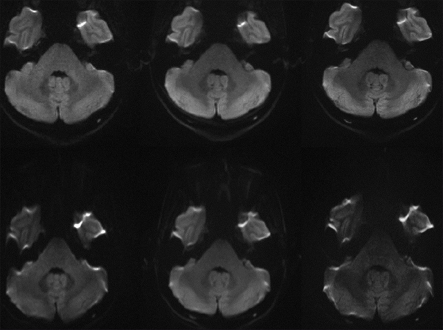 Representative images at 3 T including: single-shot echo planar imaging (ss-EPI) (bottom left) and readout-segment echo planar imaging (rs-EPI) obtained with a 12-channel head coil (top left), as well as well-as low artifact (IPAT 3) 32-channel coil scans with rs-EPI (top middle) and ss-EPI (bottom middle), in addition to high resolution rs-EPI (top right) and ss-EPI scans (bottom right). Note the marked pontine stretching present with the ss- EPI scans, particularly with the high-resolution image.