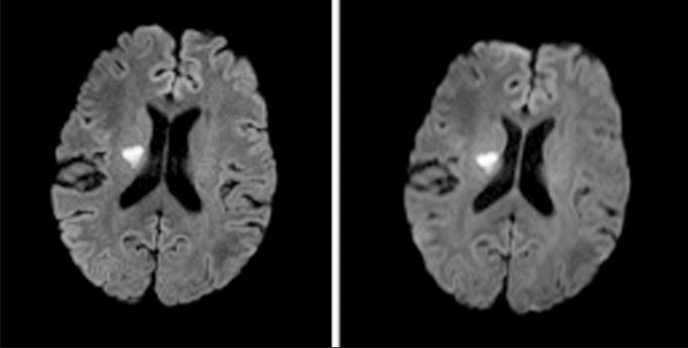 A 63-year-old man with a focus of acute ischemia illustrated on 12-channel readout-segment echo planar imaging (rs-EPI) (left) and single-shot echo planar imaging (right) diffusion-weighted imaging scans. Note the reduction in susceptibility artifact at the junction of the frontal lobes and frontal sinus with rs-EPI and also the improved sulcal definition, reflecting the higher real spatial resolution of rs-EPI.