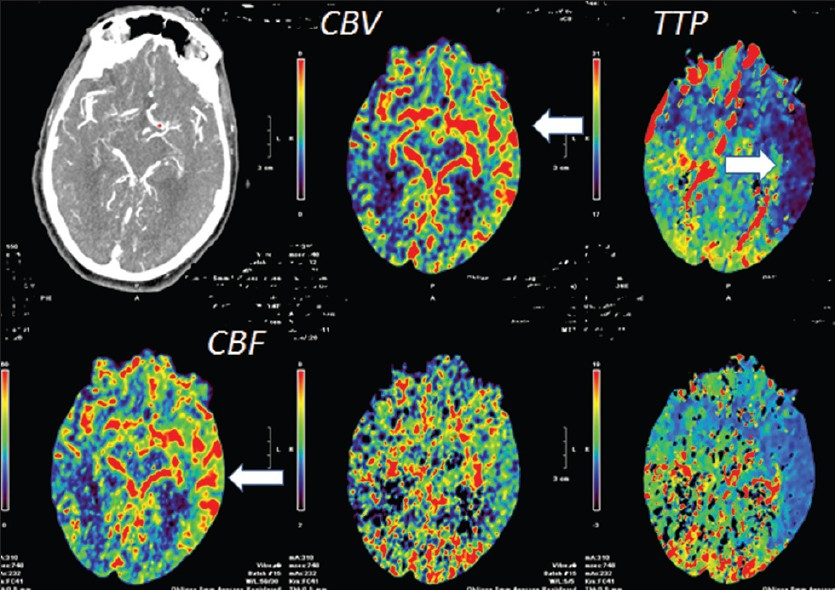 CT perfusion axial view at the level of the sylvian fissure demonstrate reduced TTP (white arrows) in the parietal-temporal lobe with corresponding increase in cerebral blood flow (CBF) (white arrows) and cerebral blood volume (CBV) (white arrows) suggestive of increased blood flow in these areas. There was no much observable change in the MTT. Mean transit time (MTT), is a measure of the mean time for blood/contrast to perfuse a region of tissue. Cerebral blood volume (CBF) = CBV/MTT.