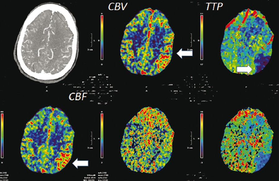 CT perfusion axial view at the cerebral high convexity level demonstrate reduced TTP (white arrows) in the parietal-temporal lobe with corresponding increase in cerebral blood flow (CBF) (white arrows) and cerebral blood volume (CBV) (white arrows) suggestive of increased blood flow in these regions.