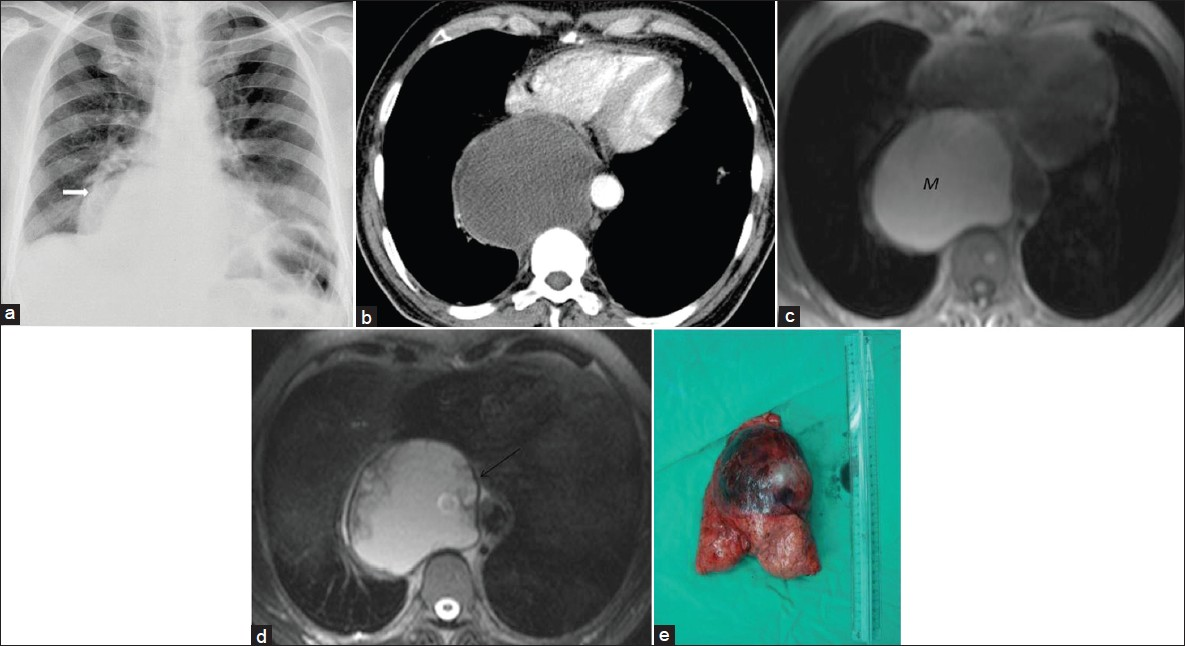 Bronchogenic cyst in an asymptomatic 50-year-old man. (a) Chest radiograph shows a sharply defined lesion of increased opacity in the right cardiophrenic angle (arrow). (b) Contrast enhanced CT shows a well -circumscribed low- attenuation lesion in the posterior mediastinum.Note posterior mediastinal mass extending into the azygoesophageal recess and pericardium. (c) Axial T1-weighted MR image shows a lesion (M) of increased signal intensity compared to CSF. (d) Axial T2- weighted MR image reveals that the lesion is of similar signal intensity as that of CSF, which suggests a cyst. The cyst capsule is seen as a well-defined low-signal intensity rim (arrow) on T2-weighted MR image. The cystic lesion exhibits septations or mural nodules. (e) Photograph of the cystic lesion.